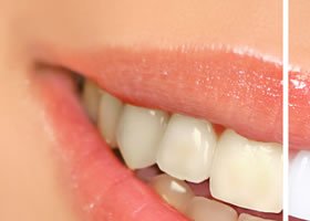 tanden bleachen voor en na basis behandeling