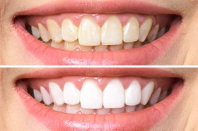teeth whitening voor en na behandeling schoonheidssalon