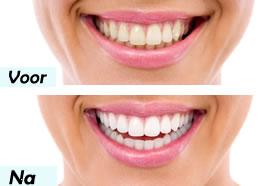 tanden bleken in 60 minuten  voor en na behandeling schoonheidssalon antwerpen schoten